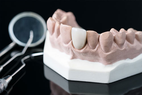 치과 및 의료용 임플란트